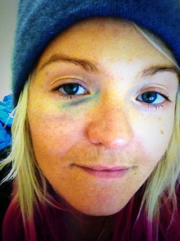 mercedessochifeb142014 Mercedes Nicoll's black eye, two days after she crash landed during halfpipe training at Sochi 2014